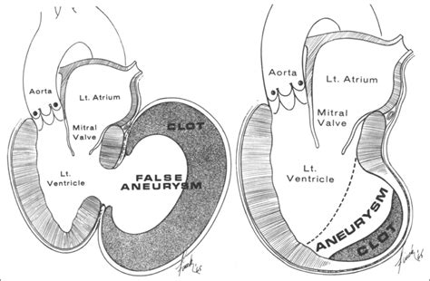 left ventricular pseudoaneurysm vs aneurysm